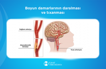 Bu müalicə də icbari tibbi sığortaya daxildir