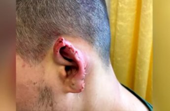 В Сумгайыте ссора между мужчинами закончилась откушенным ухом