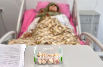 15 ildir gəzə bilmirdi, dizindən 25 daşlaşmış şiş çıxarıldı - FOTO