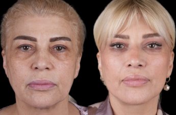 Mətanət İsgəndərli plastik əməliyyatla belə dəyişdi