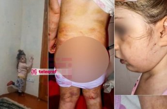 Bakıda ananın 4 yaşlı qızına verdiyi işgəncələr: Bədəni yandırılıb, kəmərlə döyülüb - TƏFƏRRÜAT
