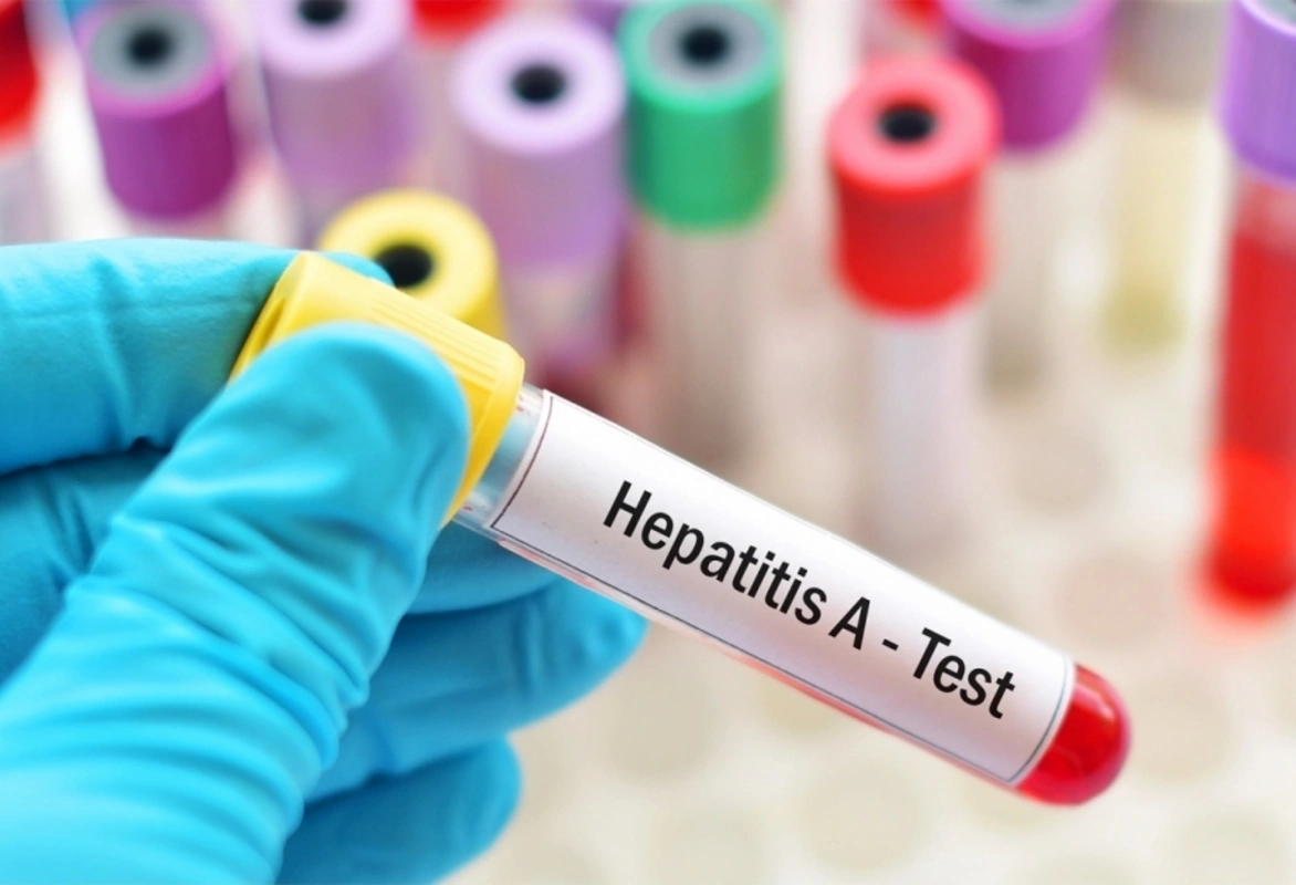 Çexiya hepatitə yoluxma sayına görə 40 illik rekordu qırıb