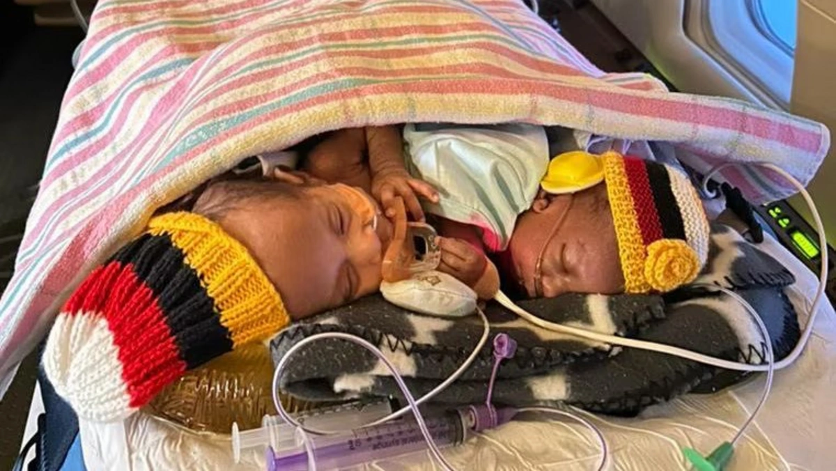 Avstraliyada siam əkizləri üzərində mürəkkəb əməliyyat: Körpələrdən biri sağ qaldı