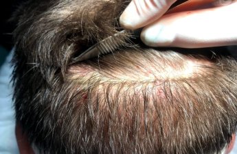 47 yaşlı kişi saç əkimi zamanı öldü