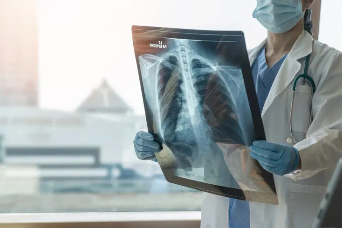 Böyük Britaniyada vərəmə yoluxma halları kəskin artıb