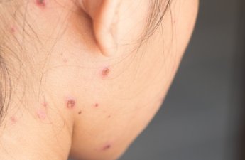 Uşaqlar arasında suçiçəyi xəstəliyi yayılıb - VİDEO