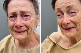 Estetik əməliyyatdan sonra inanılmaz dəyişim - VİDEO