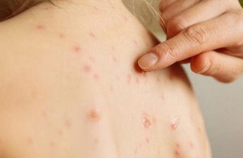 Минздрав о ситуации с ветрянкой в стране