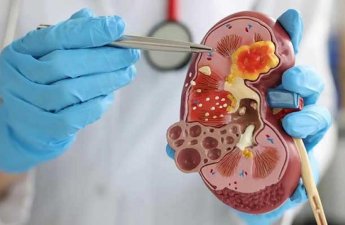 Bu qidalar böyrəkdə daş yaranmasına səbəb olur