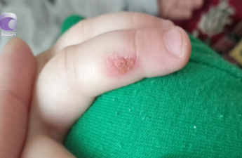 “3 yaşlı övladım dedi ki, barmağımı bağçada bibi yandırıb” - VİDEO