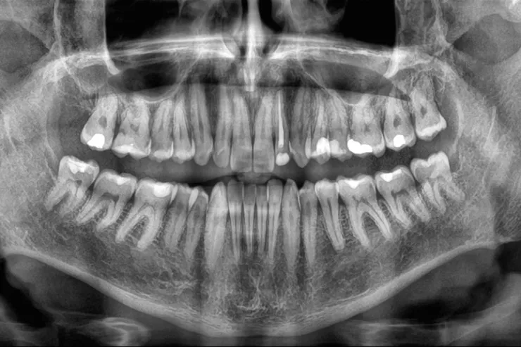 Diş itkisi ölüm riskini artıra bilər - ARAŞDIRMA