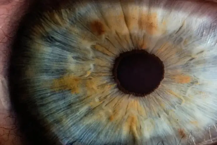 Göz skanları qocalma və ürək xəstəliyi riskini göstərə bilər - ARAŞDIRMA