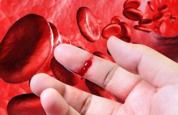 “Hemofiliya: irsi xəstəlik yoxsa idarə oluna bilən vəziyyət?” - Ekspert açıqladı