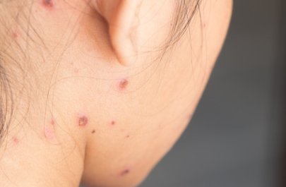 Uşaqlar arasında suçiçəyi xəstəliyi yayılıb - VİDEO